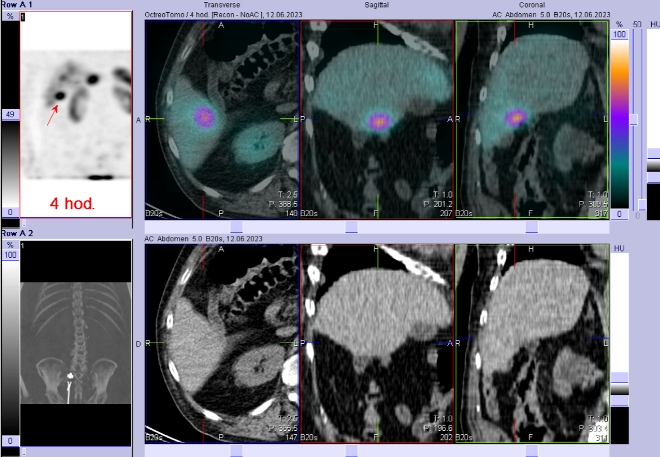 Obr. . 2: Fze SPECT/CT 4 hod. po aplikaci OctreoScanu. Zameno na loisko v pravm jaternm laloku.