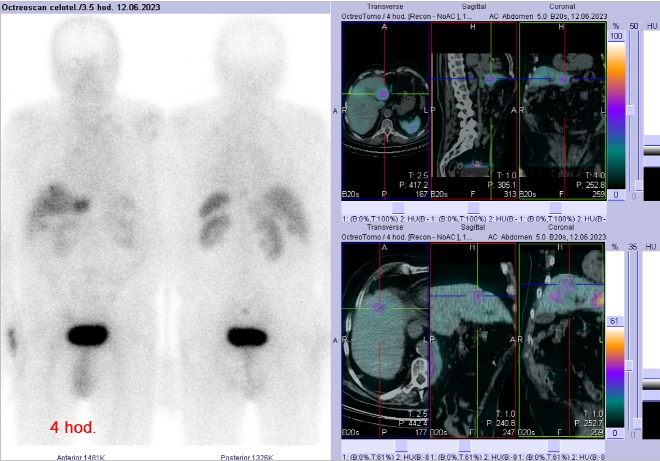 Obr. . 3: Celotlov scintigrafie a fze SPECT/CT 4 hod. po aplikaci OctreoScanu. Zameno na loiska v obou jaternch lalocch.