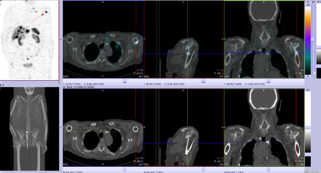 Obr. . 4: Fze SPECT/CT 24 hod. po aplikaci OctreoScanu. Zameno na loisko v lev pan kosti.