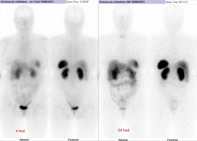 Obr. . 1: Celotlov scintigrafie 4 a 24  hod. po aplikaci OctreoScanu.