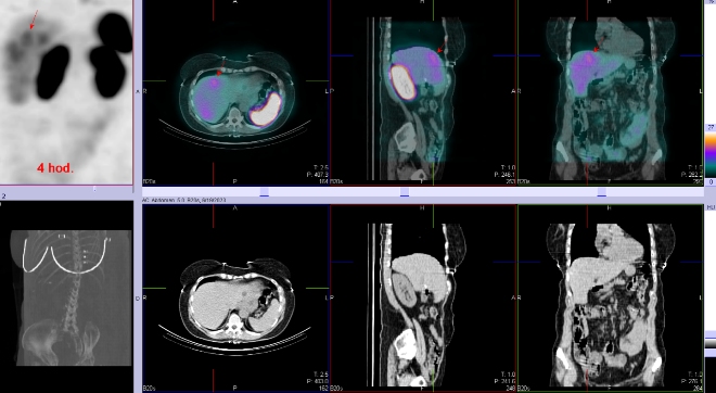 Obr. . 2: Fze SPECT/CT bicha a pnve 4 hod. po aplikaci OctreoScanu. Zameno na loisko v pravm jaternm laloku.