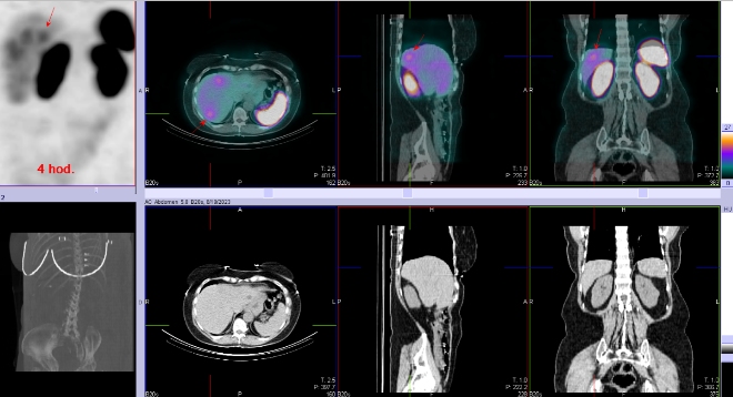 Obr. . 3: Fze SPECT/CT bicha a pnve 4 hod. po aplikaci OctreoScanu. Zameno na loisko v pravm jaternm laloku.