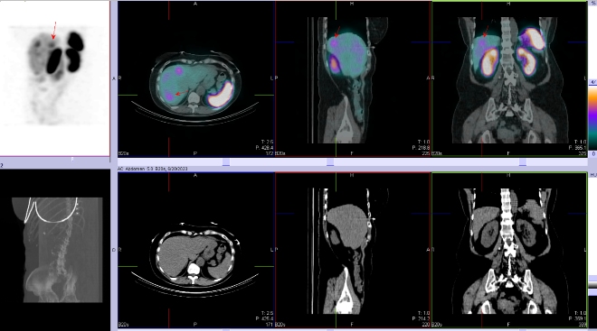 Obr. . 4: Fze SPECT/CT bicha a pnve 24 hod. po aplikaci OctreoScanu. Zameno na loisko v pravm jaternm laloku.