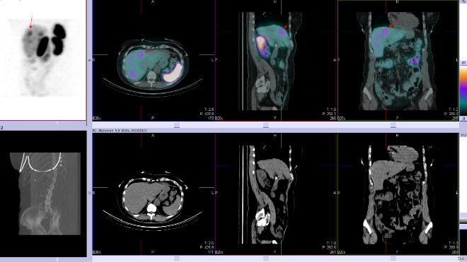 Obr. . 5: Fze SPECT/CT bicha a pnve 24 hod. po aplikaci OctreoScanu. Zameno na loisko v pravm jaternm laloku.