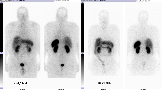 Obr.1: Celotlov scintigrafie v pedn a zadn projekci 4 a 24 hod. po aplikaci OctreoScanu.