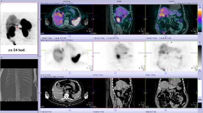 Obr..2: Fze SPECT/CT bicha a pnve 24 hod. po aplikaci OctreoScanu. Zameno na loisko v proximln sti duodena.