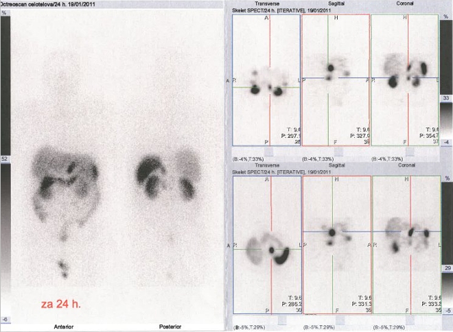 Obr. . 2: Celotlov scintigrafie a SPECT bicha a pnve 24 hod. po aplikaci radiofarmaka. Vyeten v roce 2011.