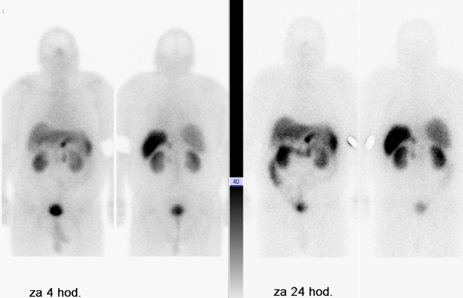 Obr. . 3: Celotlov scintigrafie v pedn a zadn projekci 4 a 24 hod. po aplikaci OctreoScanu.