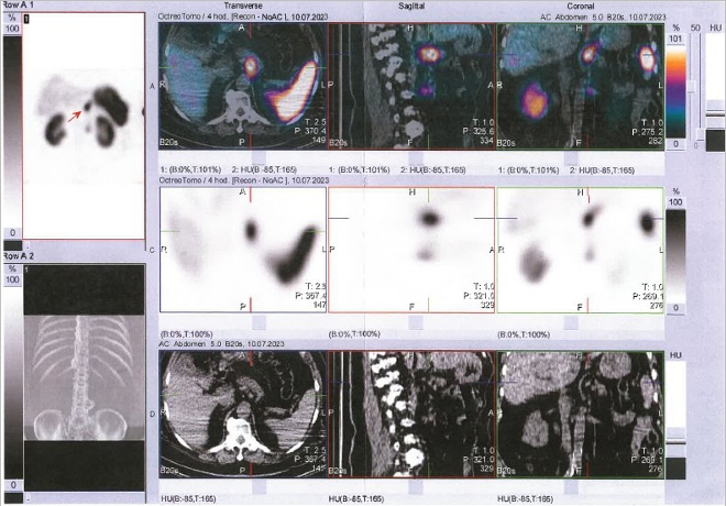 Obr. . 4: SPECT/CT bicha a pnve 4 hod. po aplikaci OctreoScanu.