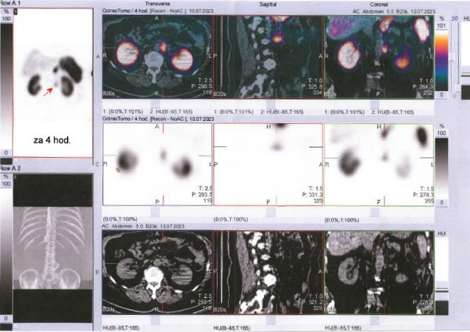 Obr. . 5: SPECT/CT bicha a pnve 4 hod. po aplikaci OctreoScanu.