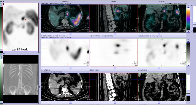 Obr. . 6: SPECT/CT bicha a pnve 24 hod. po aplikaci OctreoScanu.