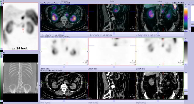 Obr. . 7: SPECT/CT bicha a pnve 24 hod. po aplikaci OctreoScanu.