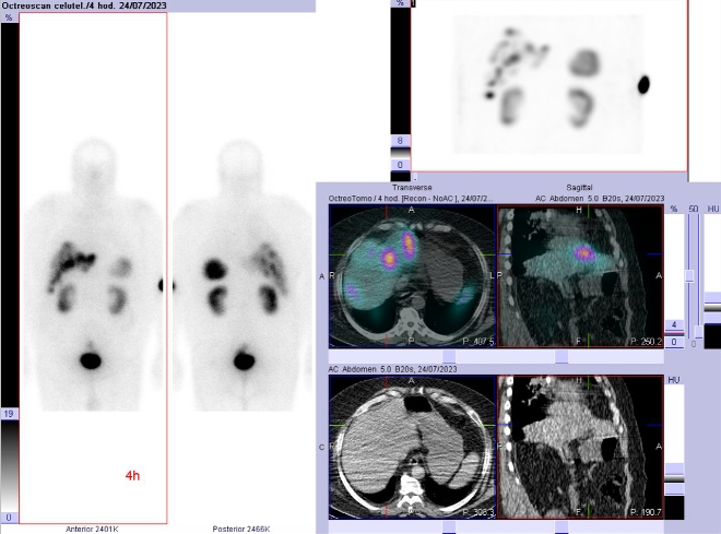 Obr. . 1: Celotlov scintigrafie a SPECT/CT 4 hod. po aplikaci OctreoScanu.