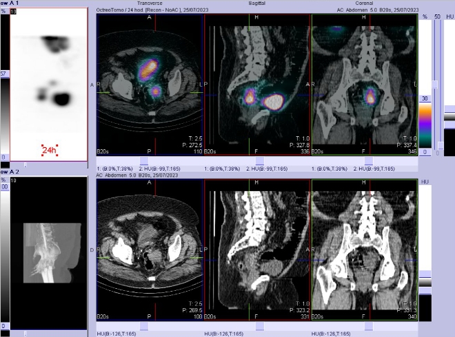 Obr. . 2: Fze SPECT/CT 24 hod. po aplikaci OctreoScanu.