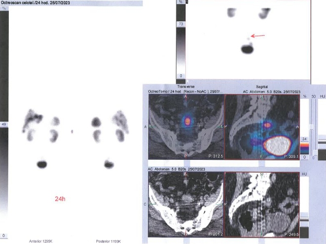 Obr. . 3: Celotlov scintigrafie a fze SPECT/CT 24 hod. po aplikaci OctreoScanu.