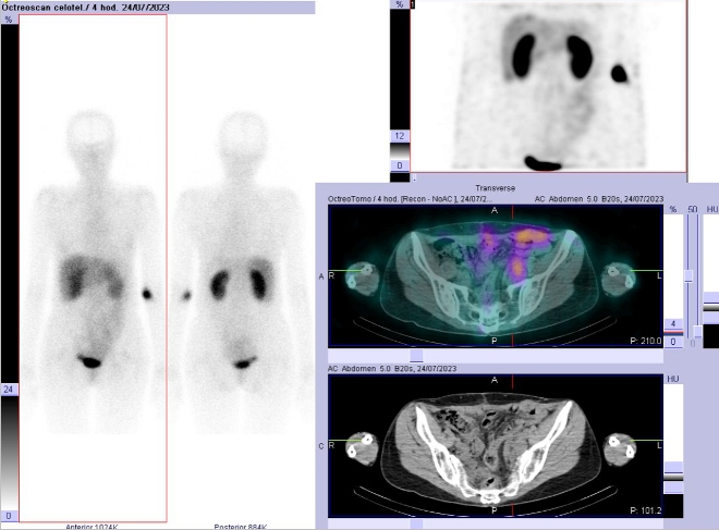 Obr. . 1: Celotlov scintigrafie v pedn a zadn projekci a SPECT/CT bicha a pnve 4 hod. po aplikaci OctreoScanu.