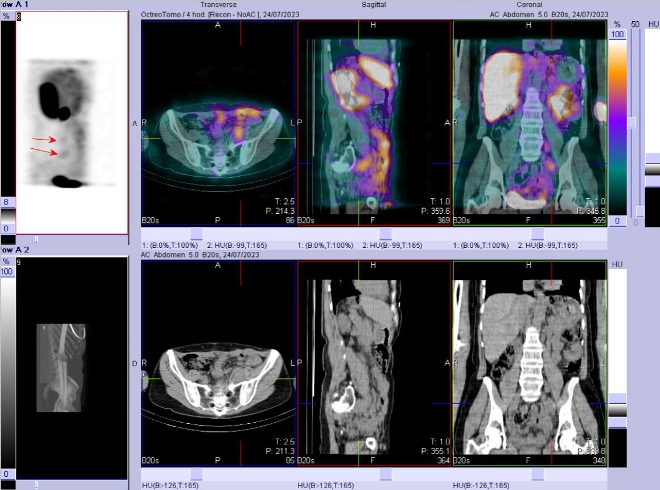 Obr. . 2: SPECT/CT bicha a pnve 4 hod. po aplikaci OctreoScanu.