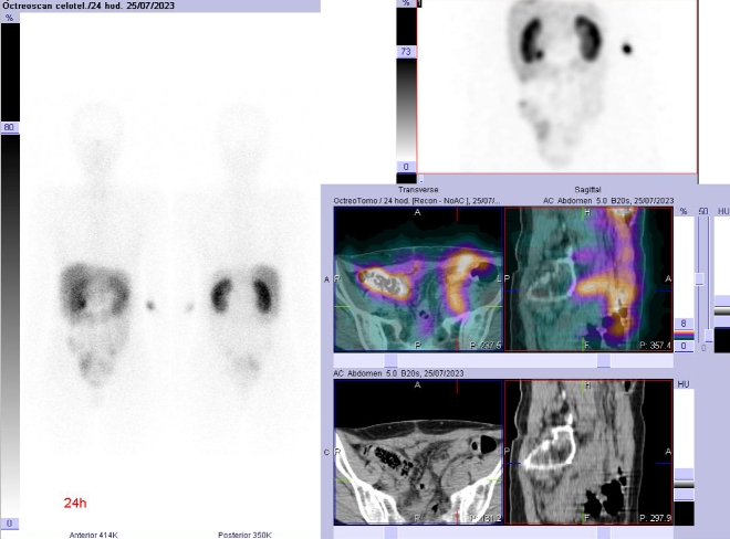 Obr. . 3: Celotlov scintigrafie v pedn a zadn projekci a SPECT/CT bicha a pnve 24 hod. po aplikaci OctreoScanu.