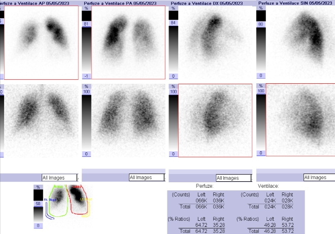 Obr .. 1: Kombinovan perfuzn a ventilan scintigrafie plic. Horn ada scintigram  perfuze, doln ada scintigram  ventilace. 