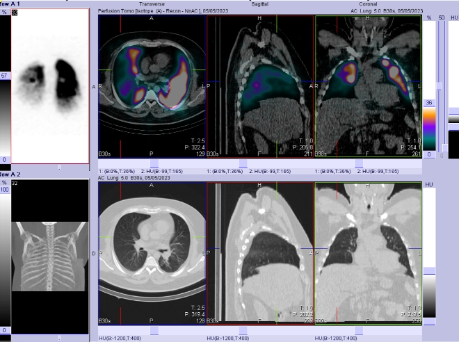 Obr. . 2 - 3: SPECT/CT plic.