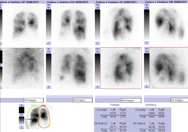 Obr. . 1: Kombinovan perfuzn a ventilan scintigrafie plic. Horn ada scintigram  perfuze, doln ada scintigram - ventilace.