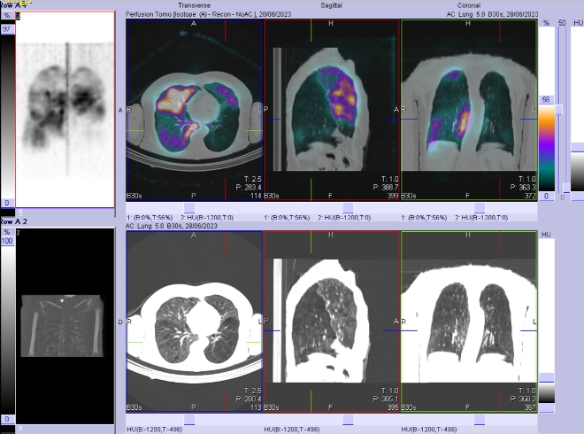 Obr. . 2: SPECT/CT perfuze plic.