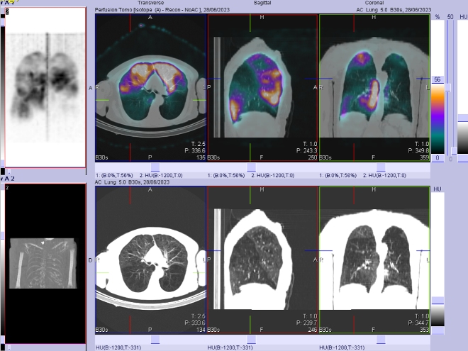 Obr. . 3: SPECT/CT perfuze plic.