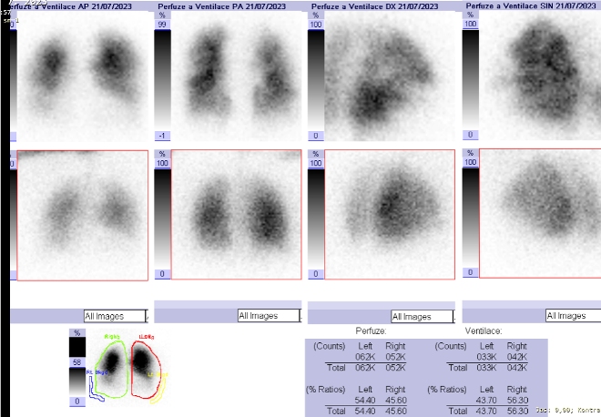 Obr..1: Kombinovan perfuzn a ventilan scintigrafie plic. Horn ada scintigram  perfuze, doln ada scintigram - ventilace.