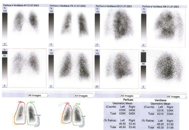 Obr. . 1: Kombinovan perfuzn a ventilan scintigrafie plic. Horn ada scintigram  perfuze, doln ada scintigram  ventilace. 