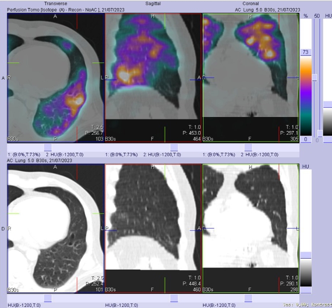 Obr. . 2-3: SPECT/CT plic.