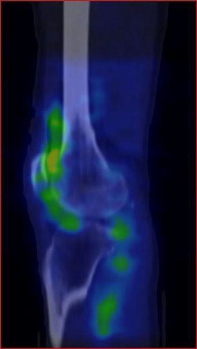 Obr.1.: SPECT/CT levho kolennho kloubu v asn fzi v sagitlnm ezu - zven krevn pool v synoviln membrn levho kolennho kloubu - scintigrafick nlez odpovd obrazu synovialitis.