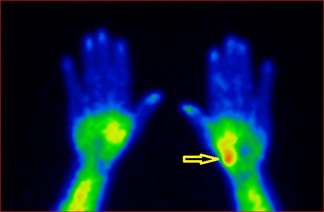 Obr.1.: 1 SPECT rukou v asn fzi - zven krevn pool v metakarpokarplnm sklouben I. prstu LHK.