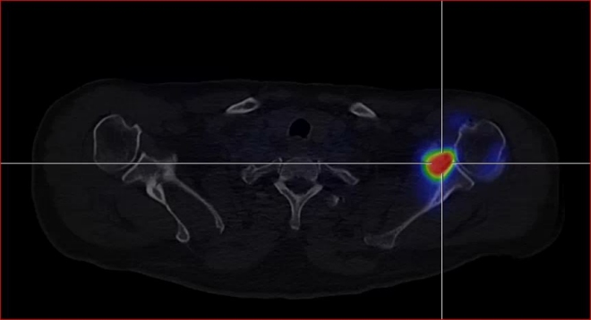 Obr.5.: SPECT/CT ramennho kloubu v asn fzi - vrazn zven krevn pool zejmna v recessu kloubnho pouzdra levho ramennho kloubu, scintigrafick nlez odpovd obrazu synovialitis.