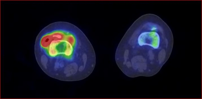 Obr.1.: SPECT/CT kolennch kloub v asn fzi v axilnm ezu - zven krevn pool v oblasti synoviln membrny pravho kolennho kloubu.