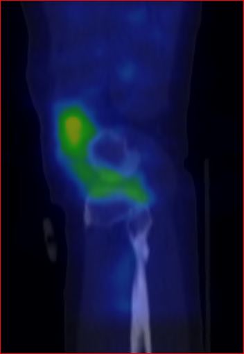 Obr.1.: SPECT/CT levho kolennho kloubu v asn fzi v sagitlnm ezu - zven krevn pool v oblasti synoviln membrny levho kolennho kloubu.