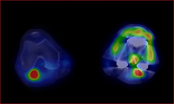 Obr.1.: SPECT/CT kolennch kloub v asn fzi v axilnm ezu - zven krevn pool v synoviln membrn levho kolennho kloubu.