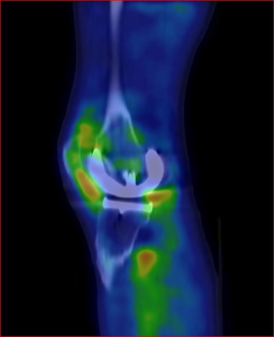 Obr.2.: SPECT/CT levho kolennho kloubu v asn fzi v sagitlnm ezu - zven krevn pool v synoviln membrn levho kolennho kloubu.