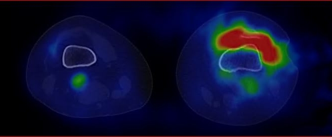 Obr.1.: SPECT/CT kolennch kloub v asn fzi v axilnm ezu - zven krevn pool v oblasti synoviln membrny levho kolennho kloubu - scintigrafick nlez odpovd obrazu synovialitis.