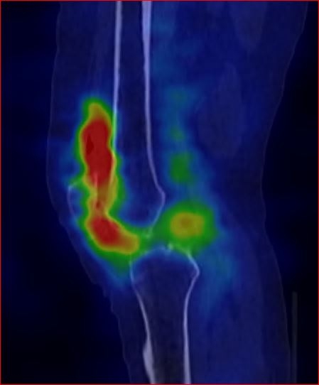 Obr.2.: SPECT/CT levho kolennho kloubu v asn fzi v sagitlnm ezu - zven krevn pool v oblasti synoviln membrny - scintigrafick nlez odpovd obrazu synovialitis.