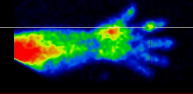 Obr.1.: SPECT prav ruky v asn fzi - na MIP rekonstrukci zven krevn pool v PIP kloubu II. prstu.